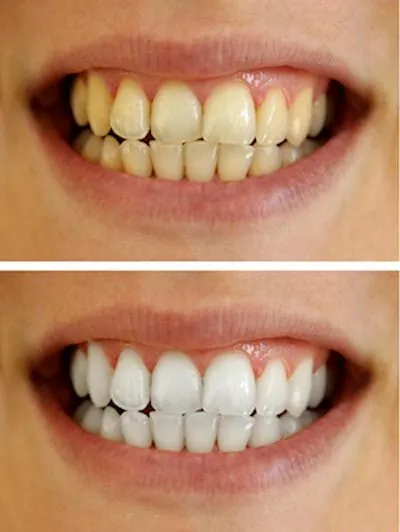 before and after teeth whitening services at Centro Dental Las Americas